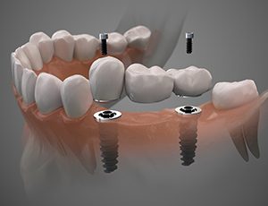 Dental bridge in Carrollton on clay model