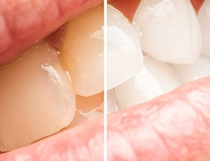 Closeup of teeth before and after teeth whitening