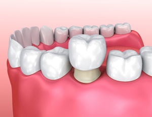 3D illustration of dental crown