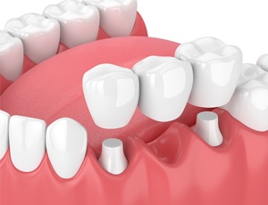 3D illustration of dental bridge