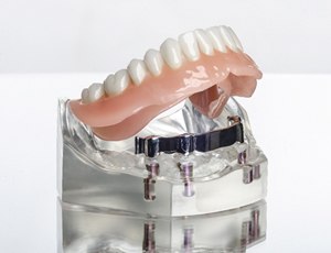 An implant-retained denture