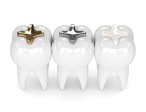 tooth with gold filling, tooth with silver filling, and tooth with composite filling