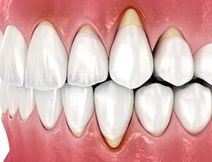 a digital illustration showing recessed gums