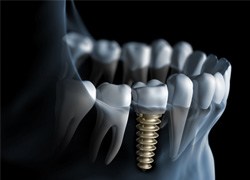 Digital illustration of dental implant