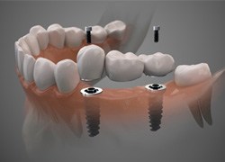 Digital illustration of dental implant bridge