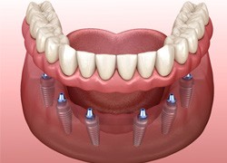 Digital illustration of implant bridge