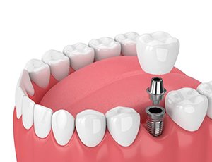 model of how dental implants in Carrollton work
