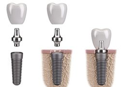 dental implant integrating with the jawbone