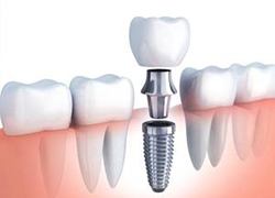 parts of a dental implant