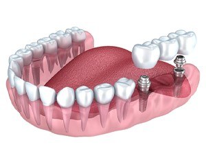 two dental implants supporting a dental bridge