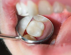 Closeup of teeth after filling placement