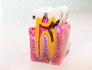 Model of damaged tooth