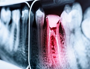 X-ray of tooth needing root canal therapy in Carrolton