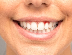 Close-up of smile with signs of gum disease