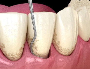 Illustration of scaling and root planing in Carrollton, TX