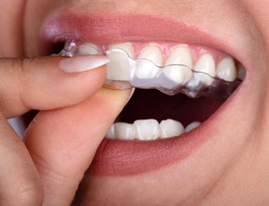 A person inserting a clear aligner