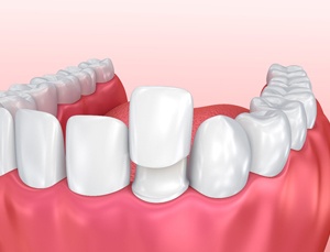 A diagram of a porcelain veneer