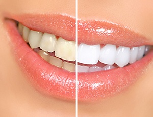 Before and after of teeth whitening