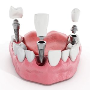 Digital model of dental implants in Carrollton replacing missing teeth.