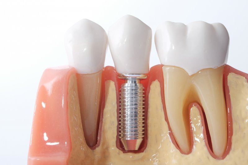 an example of dental implants in Carrollton