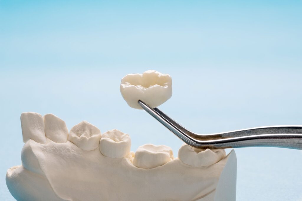 Forceps holding dental crown over model lower arch
