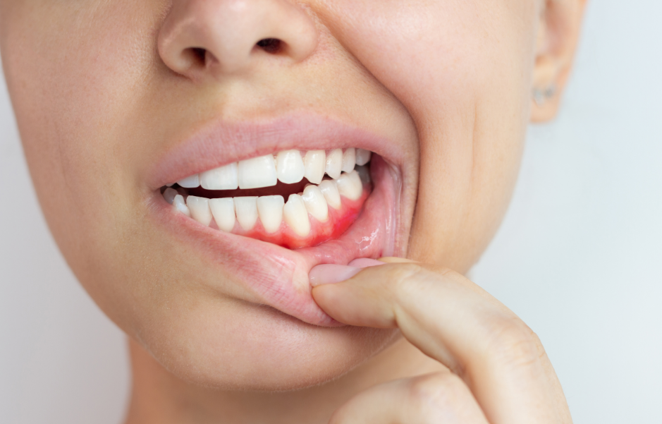 Woman showing inflammed gums