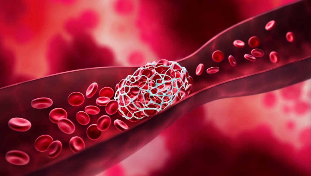 A CGI of a blood clot blocking a blood vessel